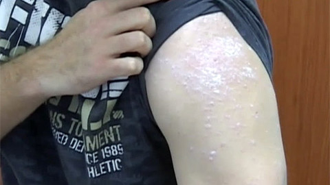 Medicína pro 21. století - Psoriáza - lupénka