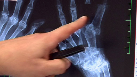 Medicína pro 21. století - Časná revmatoidní artritida