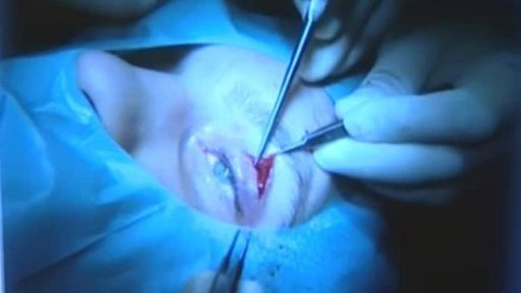 Na pomoc životu - Suché oko