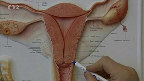 Na pomoc životu - Rakovina děložního čípku