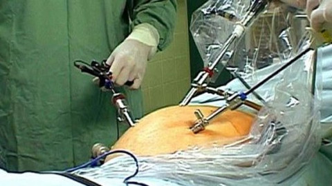 Diagnóza - Nitrobřišní laparoskopické operace