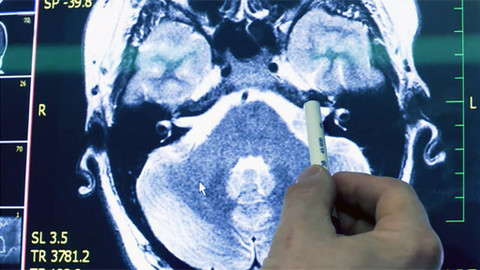 Diagnóza - Nádor sluchového nervu