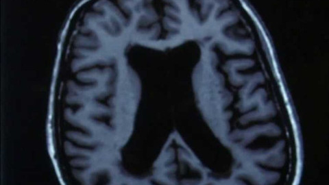 Diagnóza - Alzheimerova nemoc