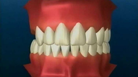 Diagnóza - Náhrada ztráty chrupu