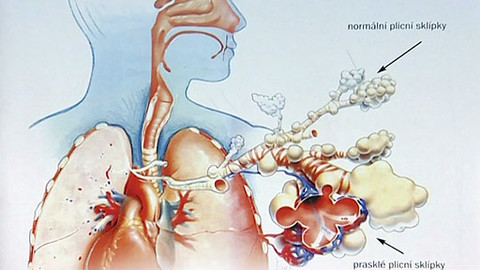 Na pomoc životu - CHOPN II