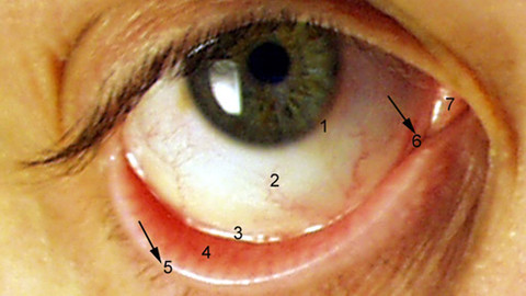 Střípky času - První transplantace rohovky na světě
