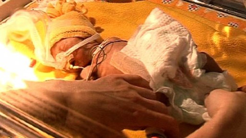 Diagnóza - Extrémní nezralost u novorozenců