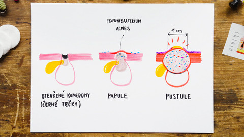 What the Fact? - Proč máme v pubertě beďary?