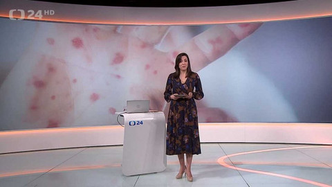 90’ ČT24 - Co jsou opičí neštovice a jak se šíří