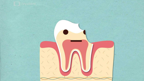 To je něco! - Jak vznikají zubní kazy?