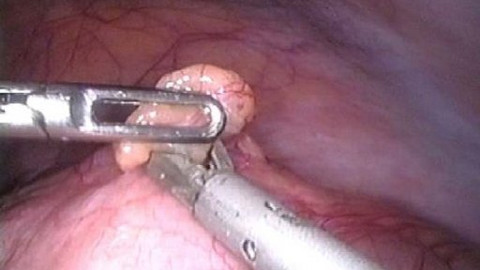 Diagnóza - Nádory tlustého střeva