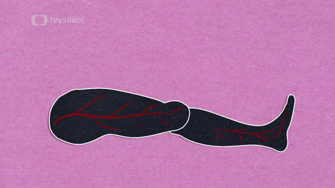 To je něco! - Co způsobuje mravenčení v noze?