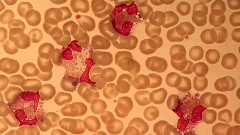 Medicína pro 21. století - Akutní leukémie