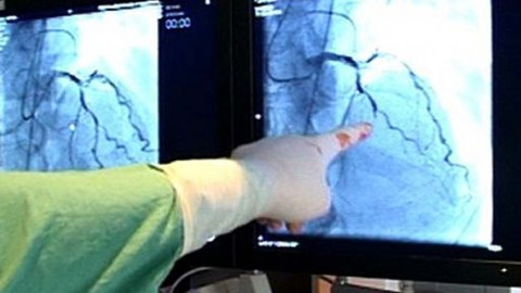 Diagnóza - Akutní infarkt