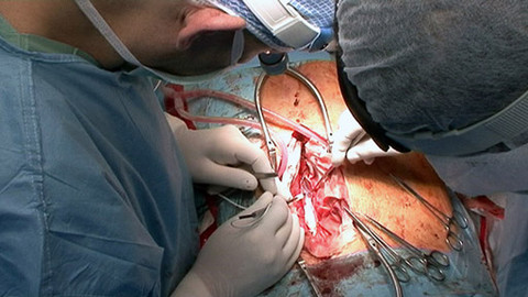 Medicína pro 21. století - Brindleyho neurostimulátor