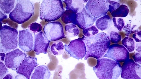 Medicína pro 21. století - Chronická myeloidní leukémie