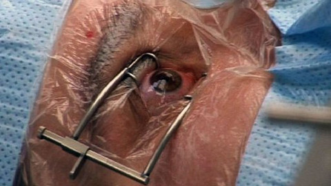 Diagnóza - Transplantace oční rohovky