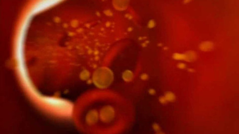 Diagnóza - Cholesterol a ateroskleróza