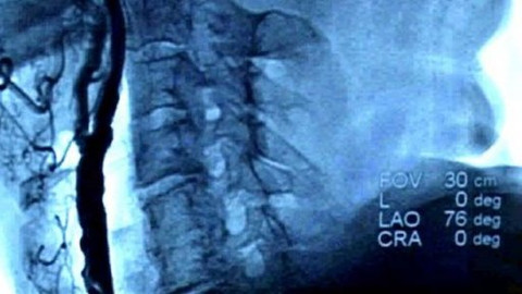 Diagnóza - Miniinvazivní léčba zúžení krčních tepen