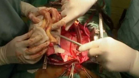 Diagnóza - Transplantace srdce