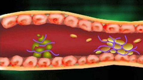 Diagnóza - Trombóza
