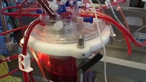 Diagnóza - Plicní hypertenze