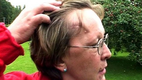 Diagnóza - Léčba mozkových výdutí