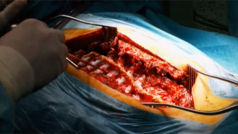 Diagnóza - Skolióza