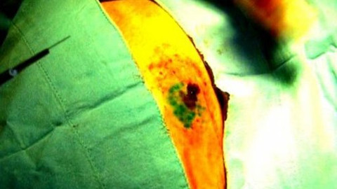 Diagnóza - Rakovina kůže