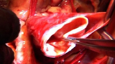 Diagnóza - Akutní disekce aorty