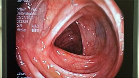 Medicína pro 21. století - Léčba střevních zánětů