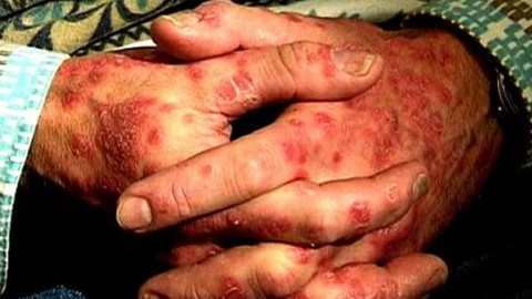 Diagnóza - Psoriáza čili lupénka