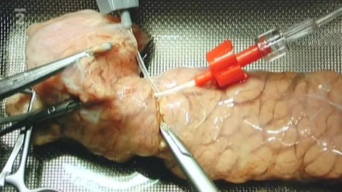 Na pomoc životu - Jak nově v léčbě diabetu