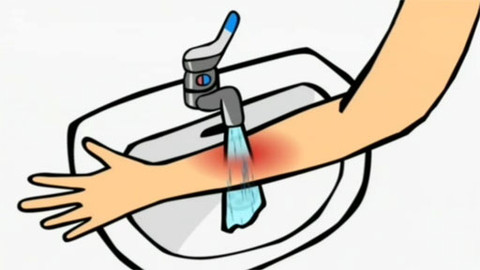 Dětská záchranka v akci - Popáleniny a opařeniny