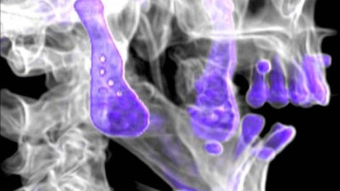 Diagnóza - Totální endoprotéza čelistního kloubu