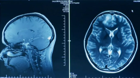Diagnóza - Nádorové onemocnění mozku