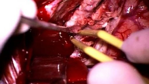 Diagnóza - Operační léčba epilepsie