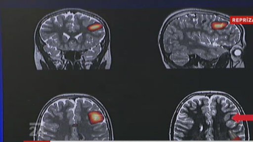 Ojedinělá operace mozku