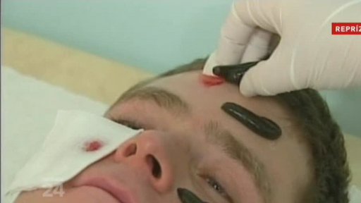 Pijavice v moderní medicíně