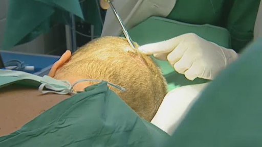 Problematika vysychání kůže a odstraňování zhoubného kožního nádoru