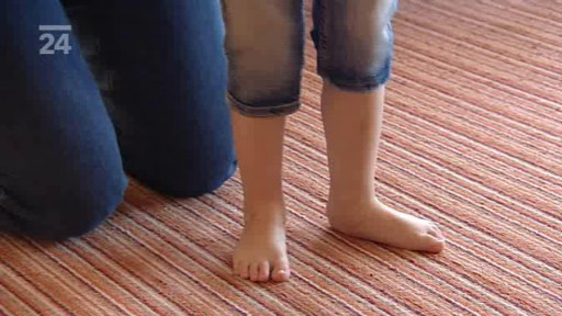 Jak se žije s tzv. clubfoot