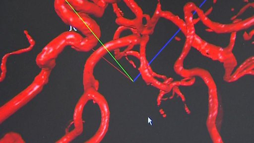Nové metody v léčbě mozkové mrtvice.