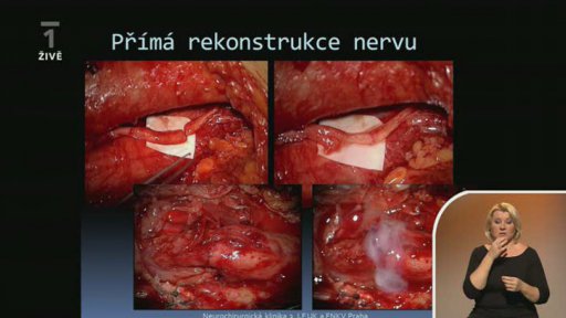 Svaly a šlachy - Prof. MUDr. Pavel Haninec, CSc. (dotazy) - 1. část