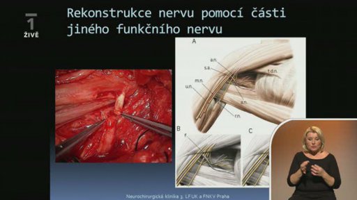 Svaly a šlachy - Prof. MUDr. Pavel Haninec, CSc. (dotazy) - 2. část