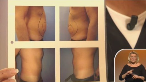 Modelace laserem - MUDr. Martin Tománek