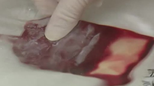 Pupečníková léčba