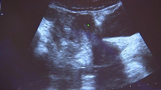 Frýdlantsko nepřijde o lůžkovou část gynekologického oddělní