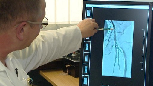 Pacienta zachránila před amputací angioplastika