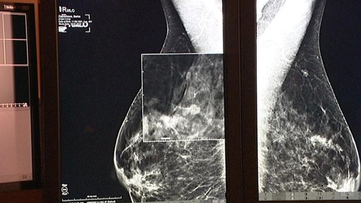 Výstava mamografických snímků v Českých Budějovicích