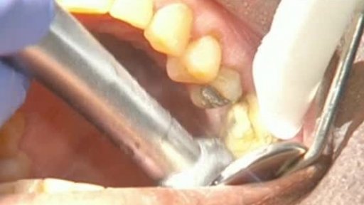 Naděje na menší bolest u zubaře